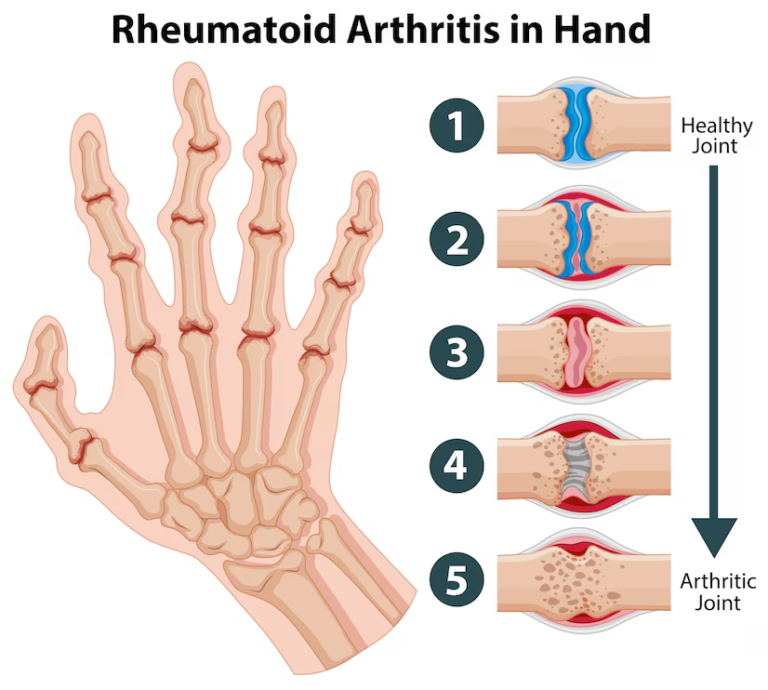 Read more about the article RHEUMATOID ARTHRITIS